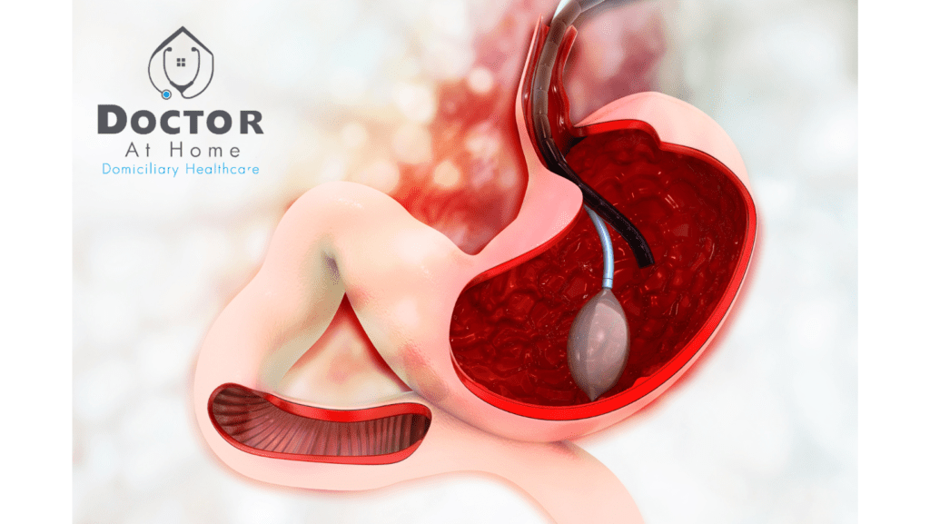 Intragastric Balloon in Guadalajara