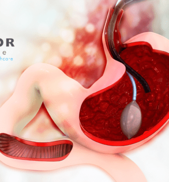 balón intragástrico guadalajara Intragastric balloon